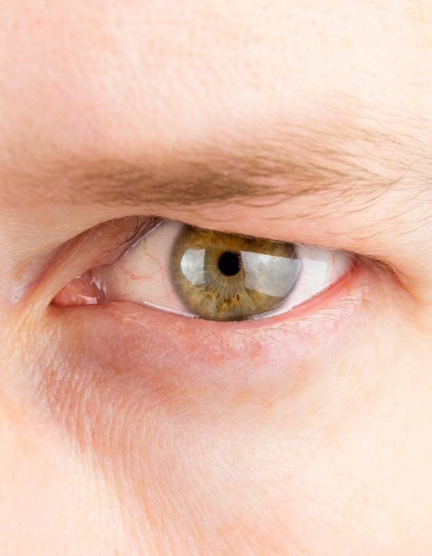 HR Plastic Sugery - Droopy eyelids - Eyelid bags - Loose excess eyelid skin Common Causes